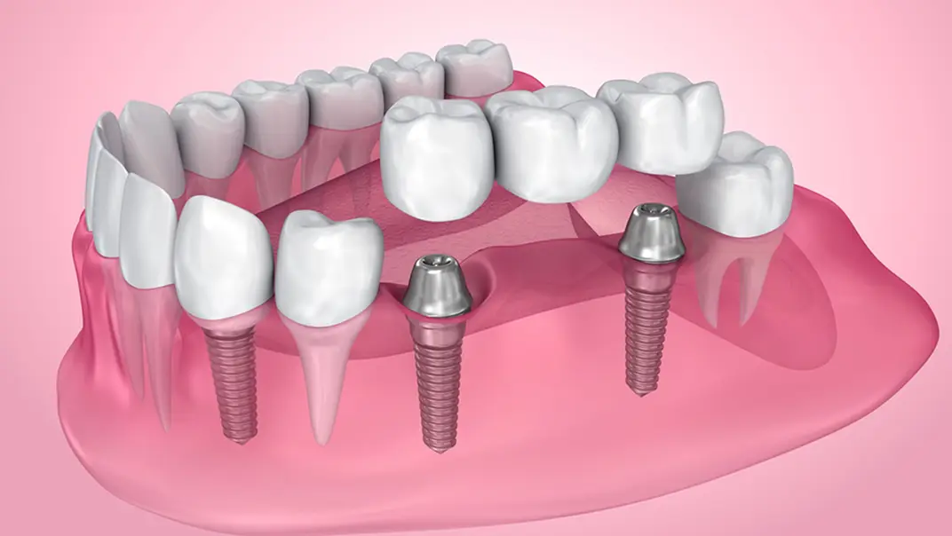 Celebrity dental implants before and after - ILAJAK Medical