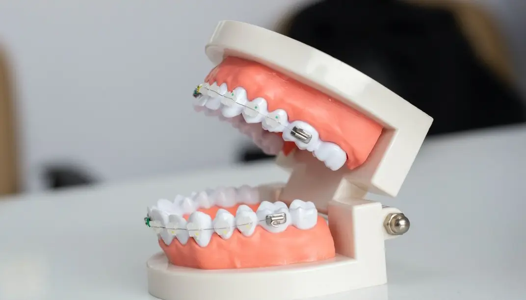 The Cost of Dental Braces in Turkey 2024 ILAJAK Medical