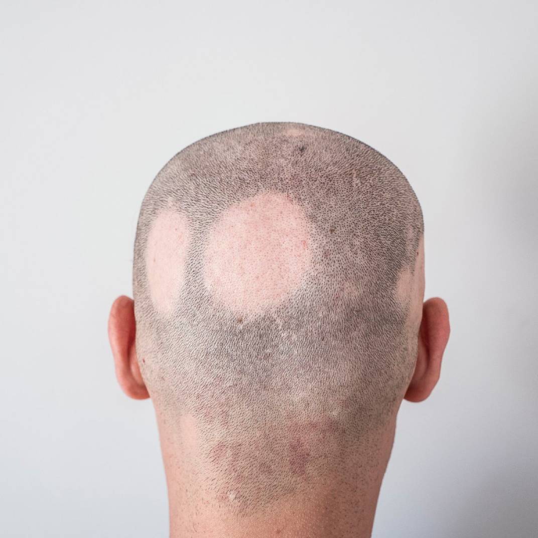 Quel Sont Les Traitements Naturels De La Pelade علاجك الطبية Quel Sont Les Traitements Naturels De La Pelade علاجك الطبية