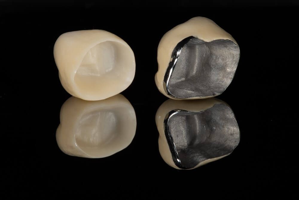 إيلجاك أسنان البورسلين الطبي: المزايا والمخاطر والتكاليف