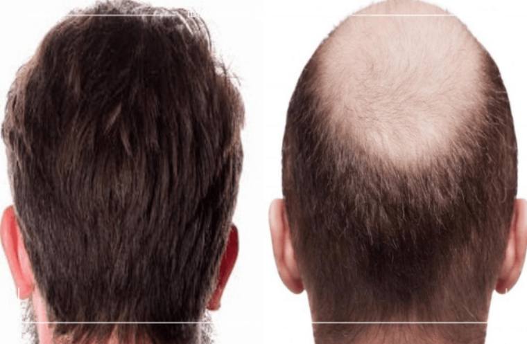 زراعة الشعر قبل وبعد بالصور في مراكز علاجك الطبية | علاجك الطبية