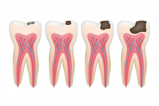 what is tooth decay and its types? | ILAJAK Medical