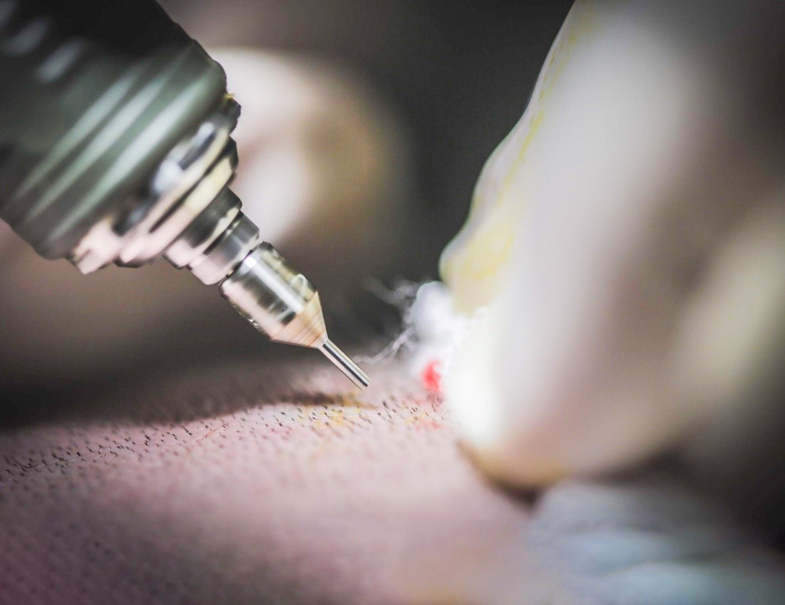 هل زراعة الشعر في تركيا أفضل أم مصر؟ الفرق بين زراعة الشعر في مصر وتركيا 2021