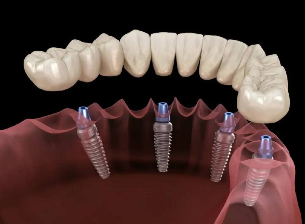 Dental implants in Istanbul your complete guide ILAJAK Medical