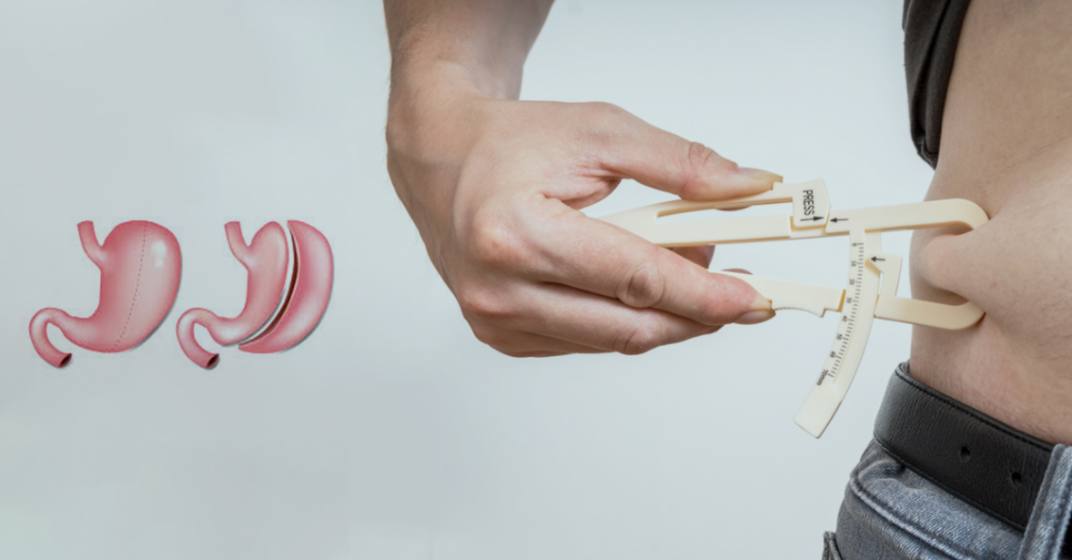 Weight loss surgery in turkey reviews ILAJAK Medical