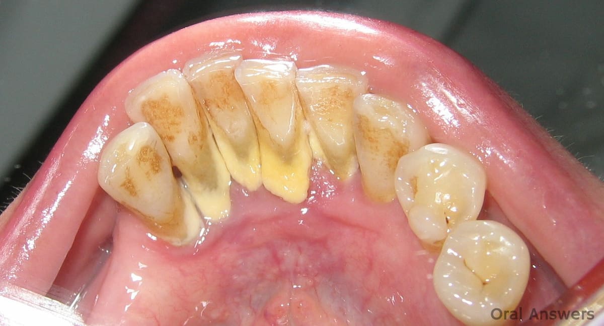 Remove tartar from teeth at home discount