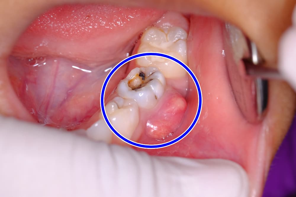 اعراض خراج الاسنان
