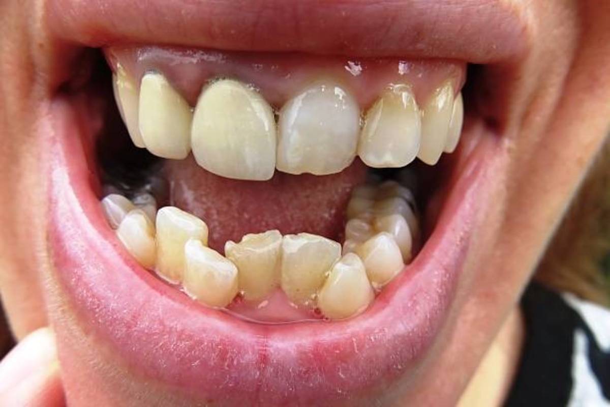 كيس سنة جديدة قاعدة  ما سبب اعوجاج الأسنان وكيف يتم علاجه؟ | Ilajak médical