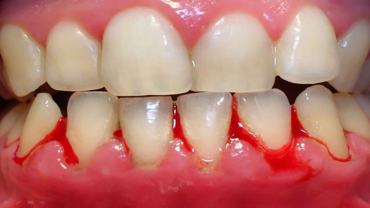ما تحتاج لمعرفته حول نزيف اللثة | علاجك الطبية