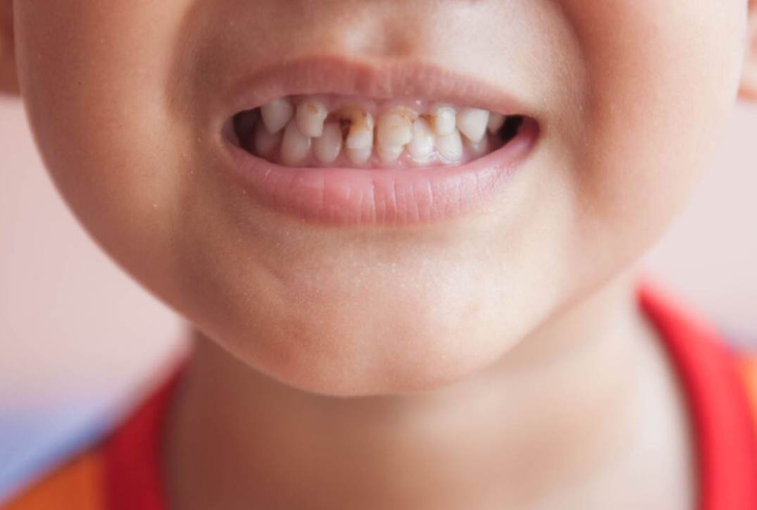 علاج تسوس الأسنان