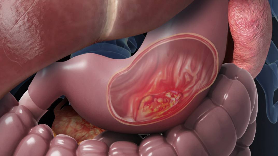 Opération du cancer de l'estomac |  علاجك الطبية