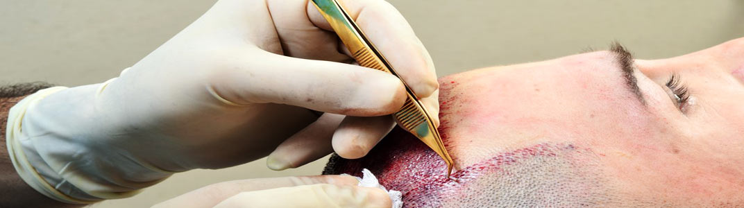 هل زراعة الشعر في تركيا أفضل أم إيران ؟ الفرق بين زراعة الشعر في ايران وتركيا 2021
