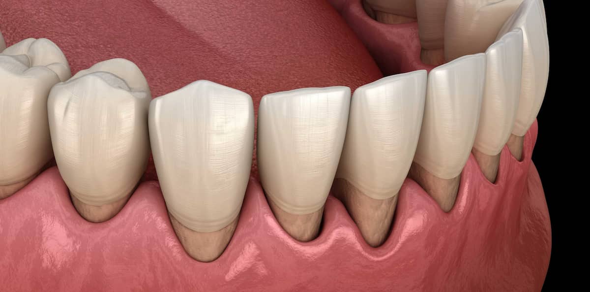 Récession gingivale causes, symptômes et traitements Ilajak médical