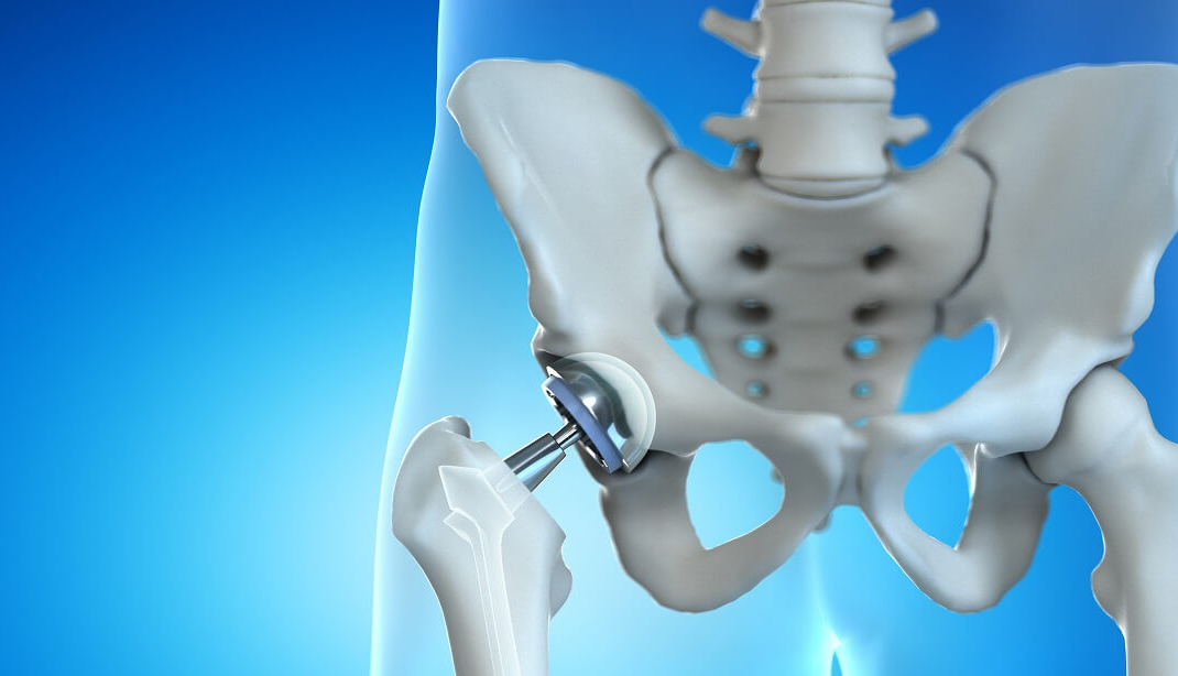 كل ما تريد أن تعرف عن استبدال مفصل الورك علاجك الطبية