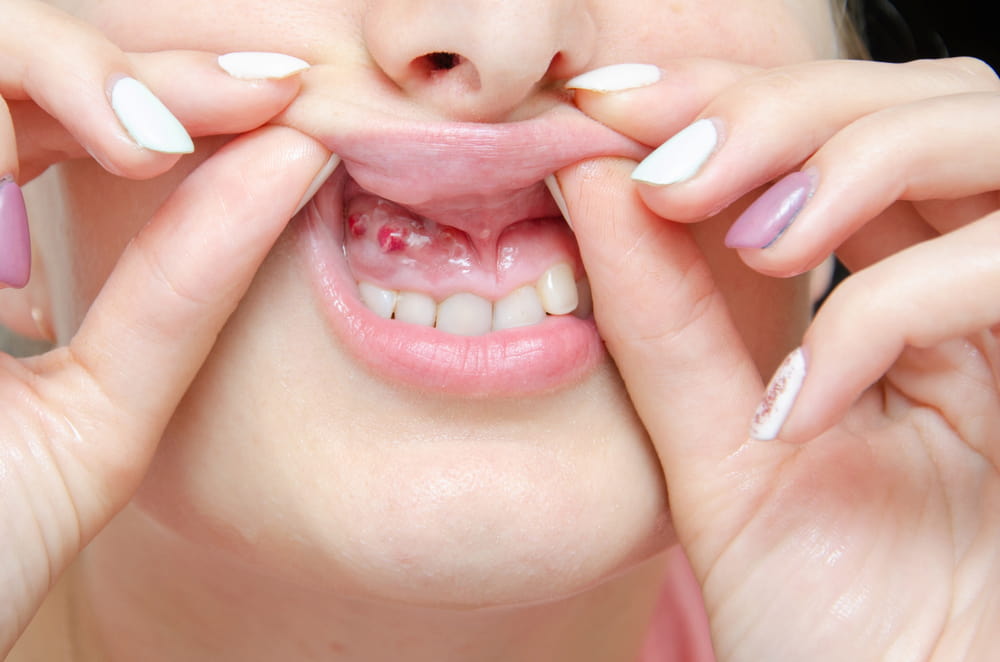 Guide complet sur les aphtes des gencives | Ilajak mdical
