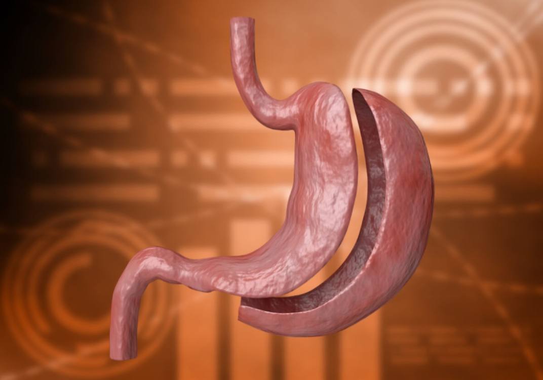 Gastric Sleeve Cost in Turkey ILAJAK Medical