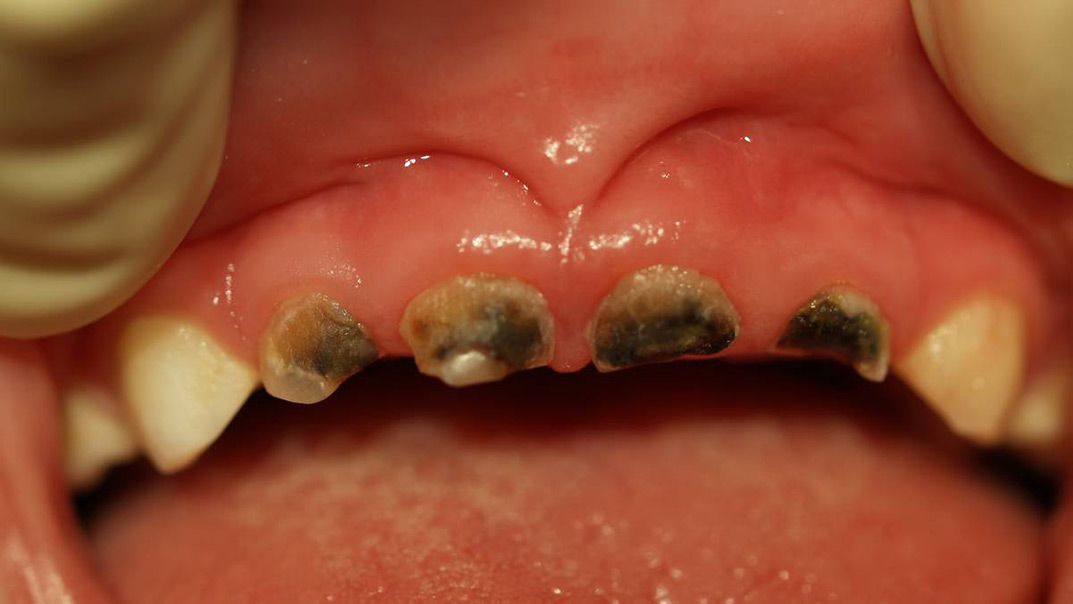 What are the symptoms of tooth decay in children?