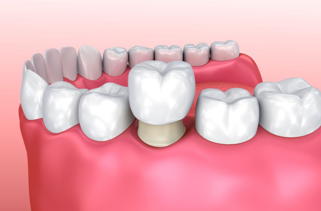 Corona dental: els seus avantatges i inconvenients i com instal·lar-la | El seu tractament mèdic