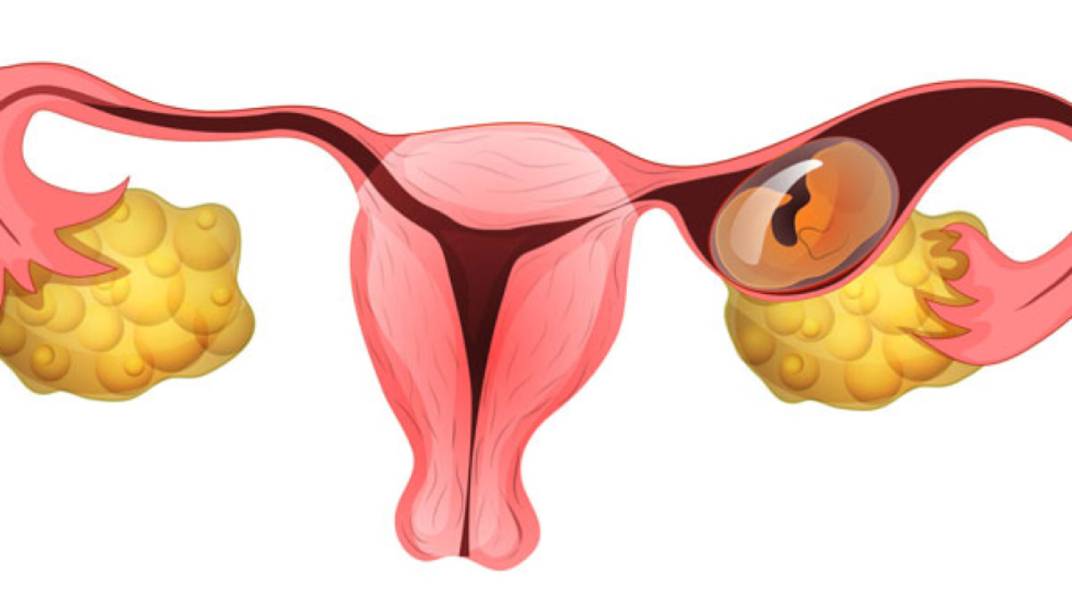 Plan B Ectopic Pregnancy

