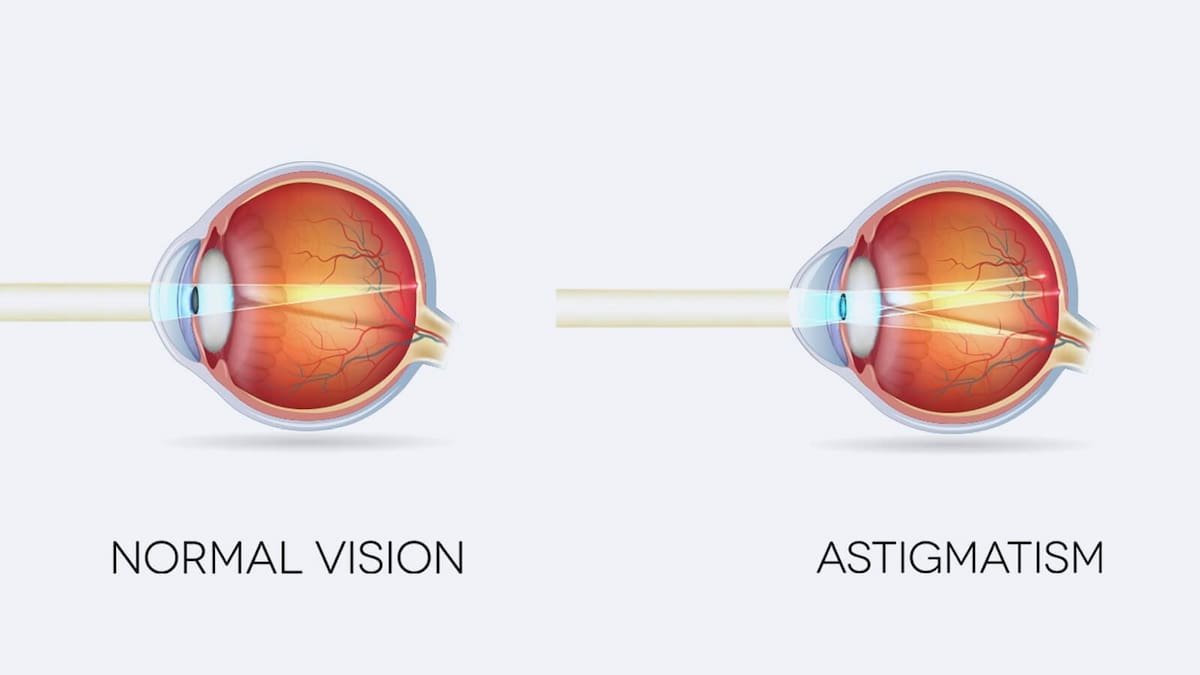 L astigmatisme Causes Et Traitements Ilajak M dical