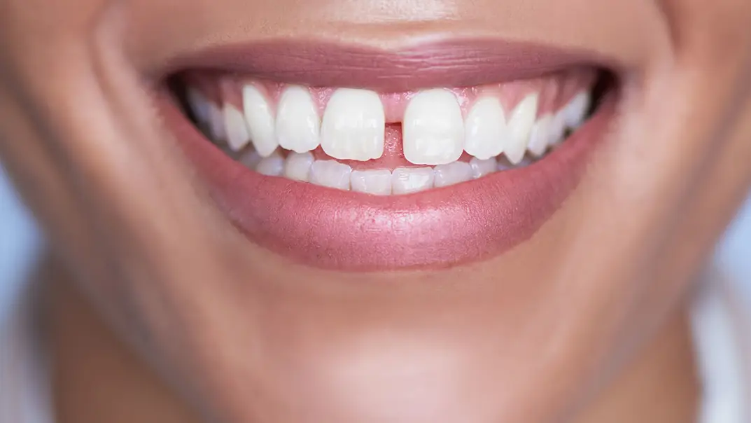 Best 3 ways to fix teeth gap without braces ILAJAK Medical