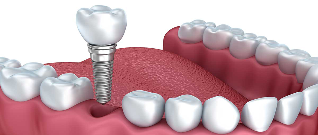 teeth implant 