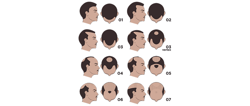  treatment of baldness in men