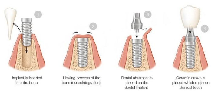Dental implant procedure