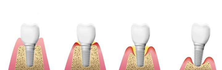 Suturing dental implants