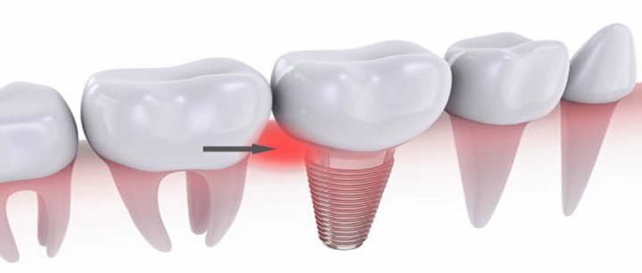 Treatment for dental implant gingivitis