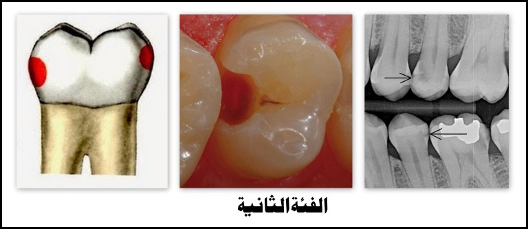 تسوس يؤثر على الأسطح الدانية 