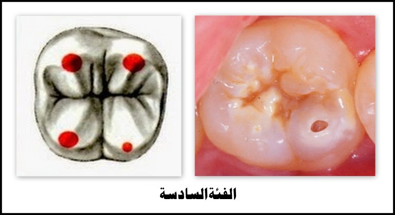 تسوس الحواف القاطعة للأسنان الأمامية