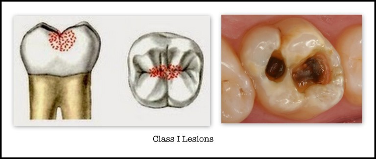 Cavities located in pits or fissures