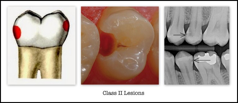 Cavities located in the proximal surfaces of molars and premolars.