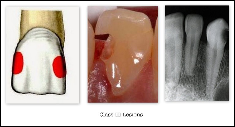 Cavities in the proximal surfaces of canines