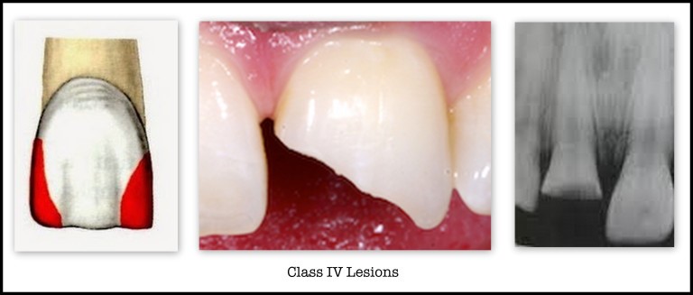 Cavities in the proximal surfaces 