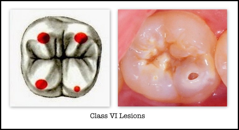Cavities on incisal edges