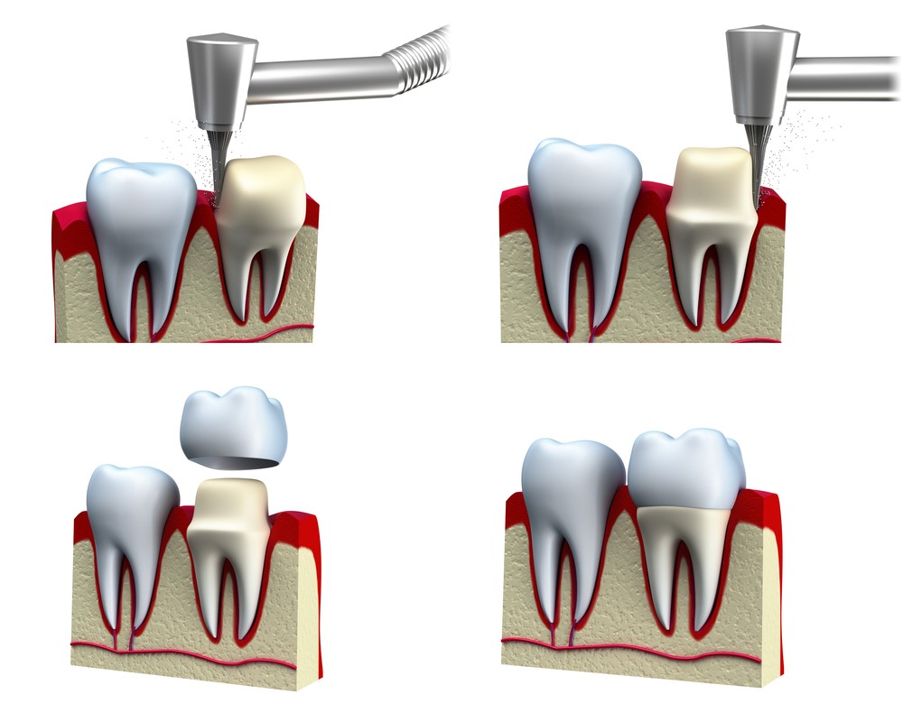 Tooth crown procedure