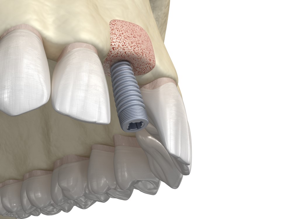 Bone graft from hip to jaw