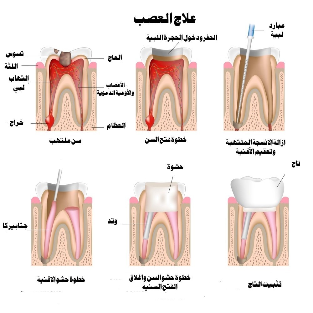 علاجك الطبية حشو وسحب العصب كيف يتم وهل هو مؤلم
