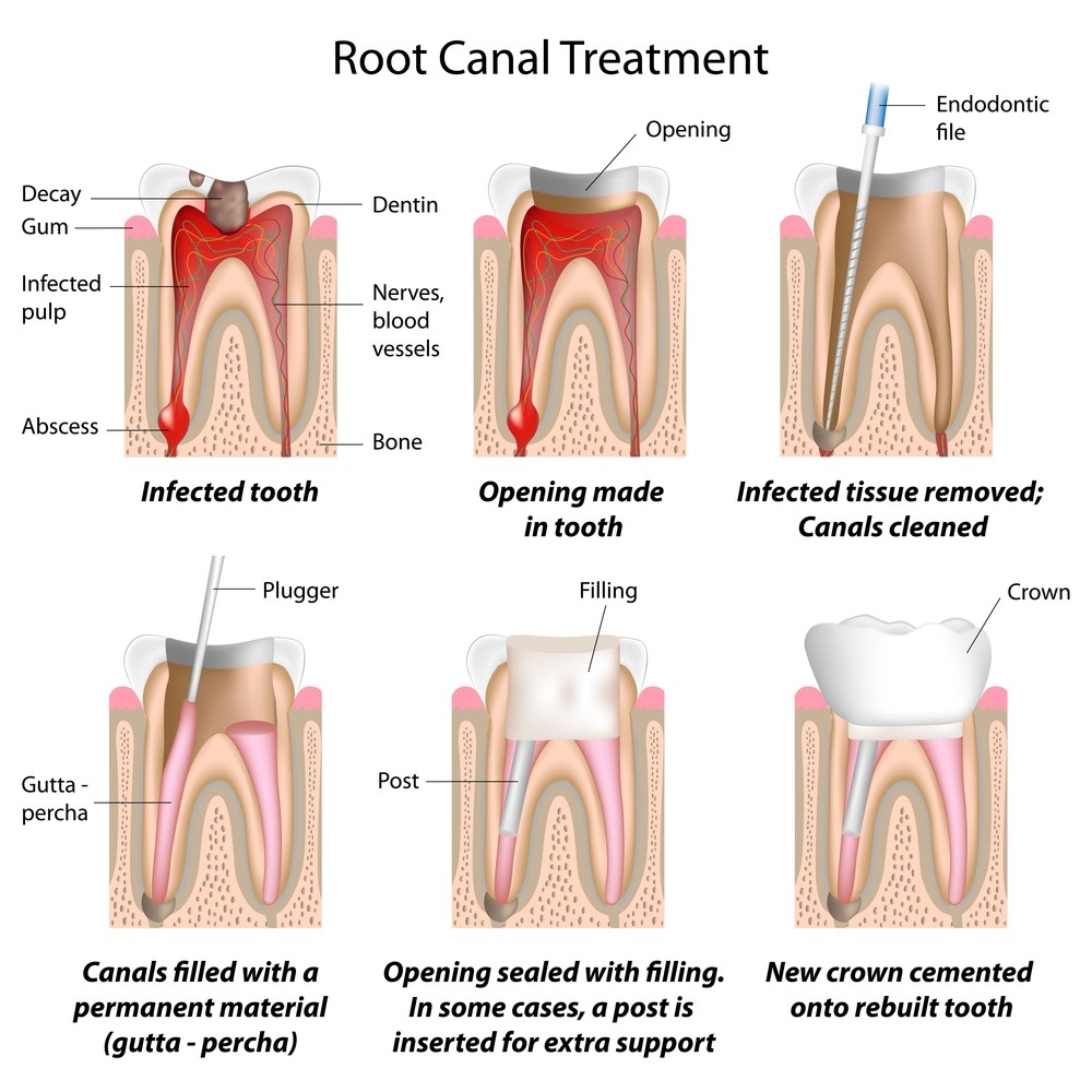 Root canal treatment steps