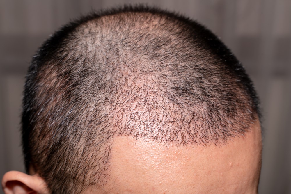 تعرف على زراعة الشعر بتقنية الاقتطاف FUEوتكاليفها | علاجك الطبية