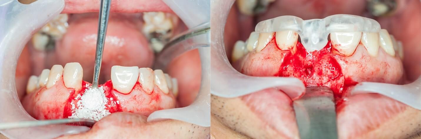 Dental bone graft healing pictures