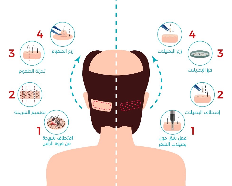 ما هي مراحل زراعة الشعر؟