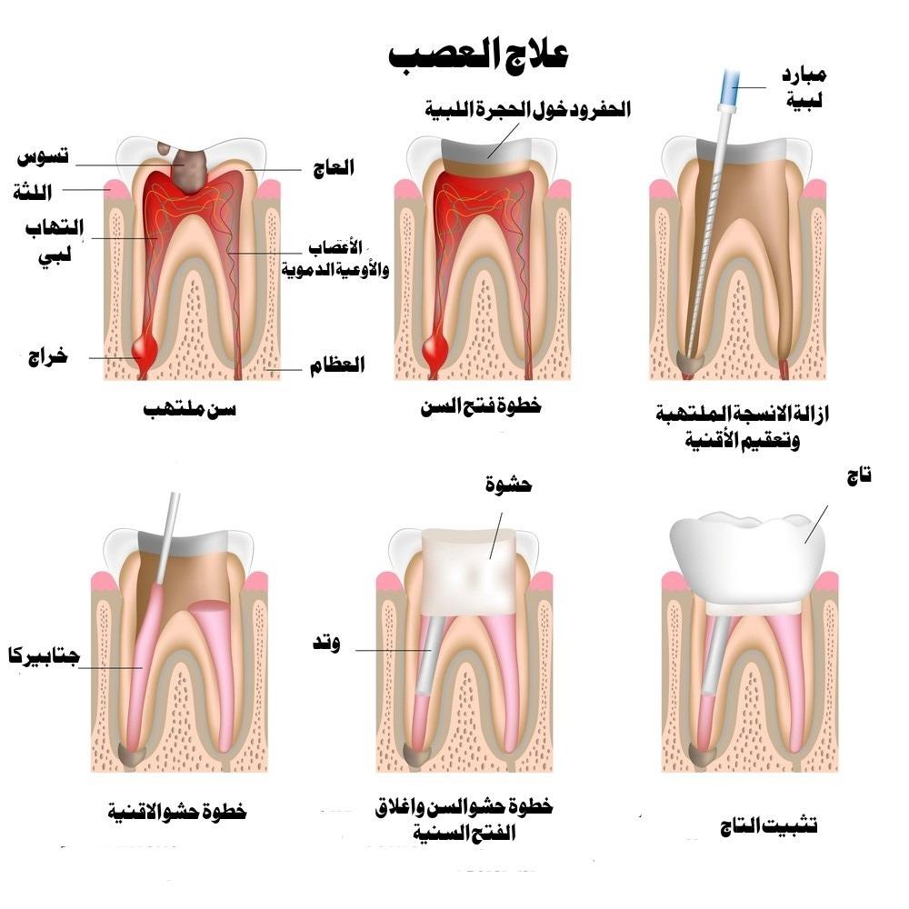 آلام في الأسنان بعد إزالة الأعصاب وتنظيف القناة كم من الوقت ستستمر وماذا تفعل