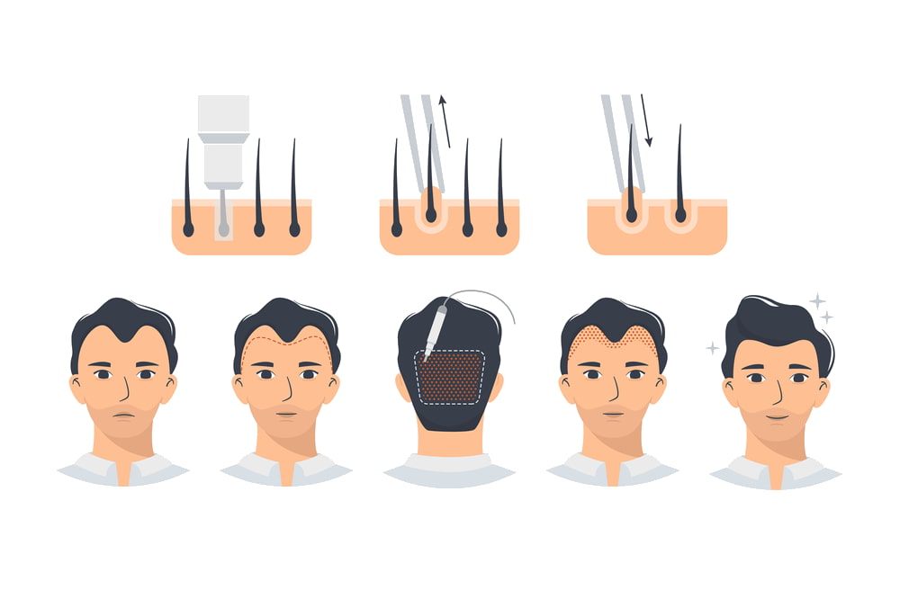 علاجك الطبية | ما هي تقنية DHI لزراعة الشعر أو ما يعرف بأقلام تشوي؟