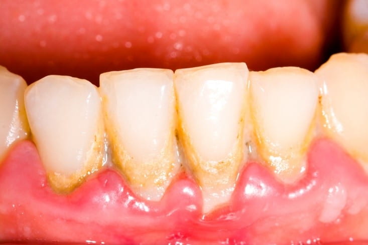 تعرف على أسباب التهاب اللثة وعلاجه علاجك الطبية