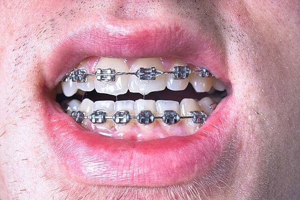 appareil dentaire metallique