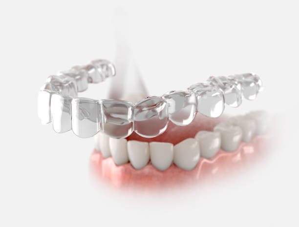 الفرق بين تقويم الأسنان المعدني والشفاف