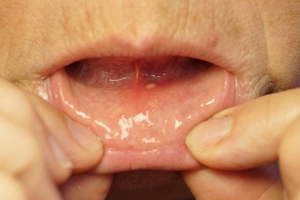 التهاب الفم بسبب طقم الأسنان لدى المسنين